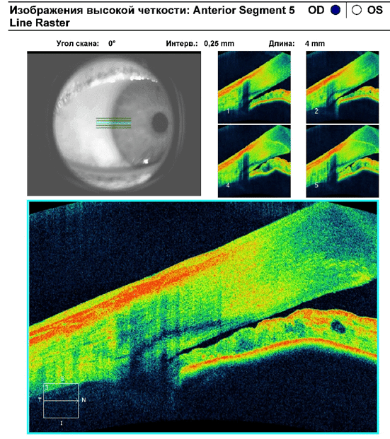 Ost оптическая когерентная томография глаза сетчатки thumbnail